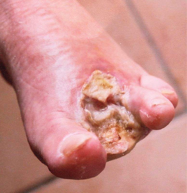 Image of a gangrenous toe week 1