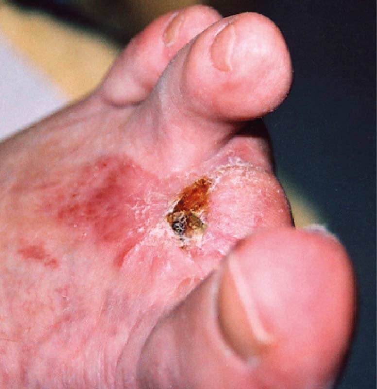Image of a gangrenous toe week 3