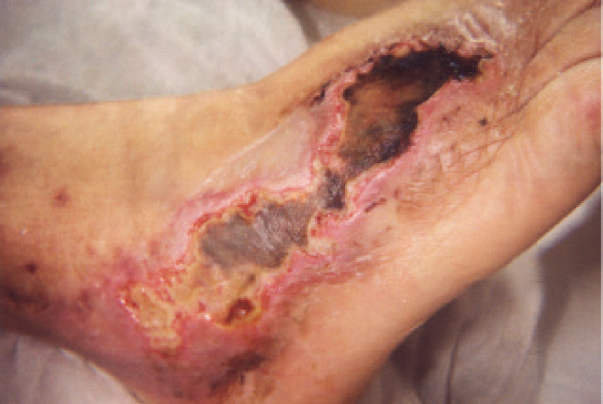 Image of a necrotic foot day 1