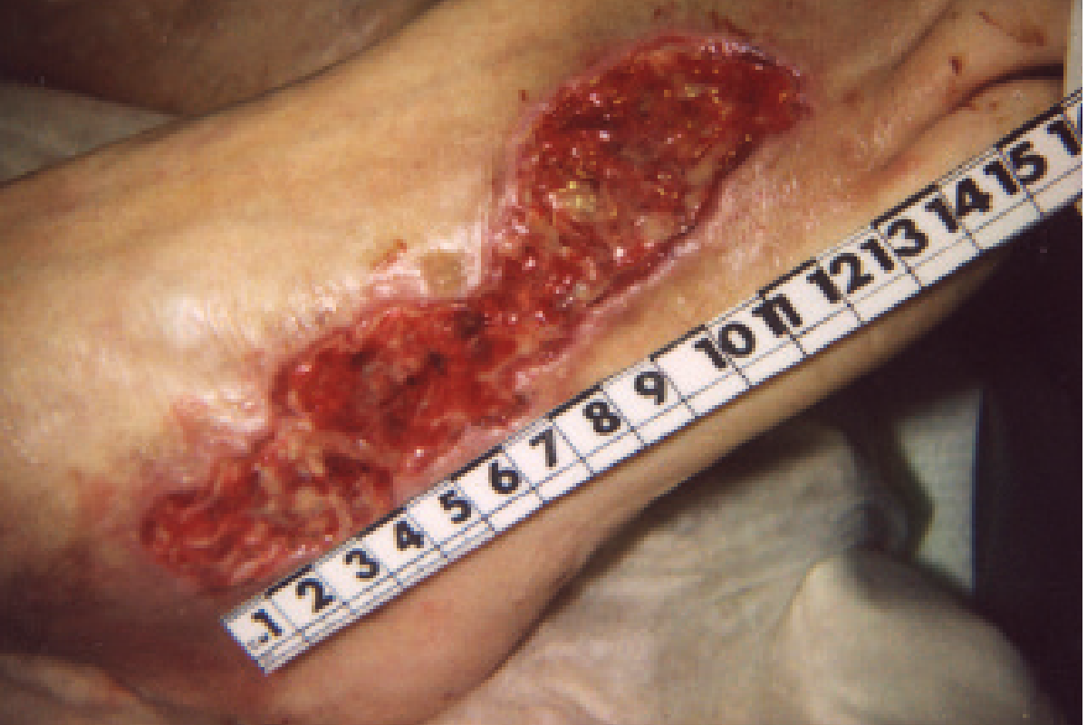 Image of a necrotic foot after treatment with ActivHeal Hydrogel day 18