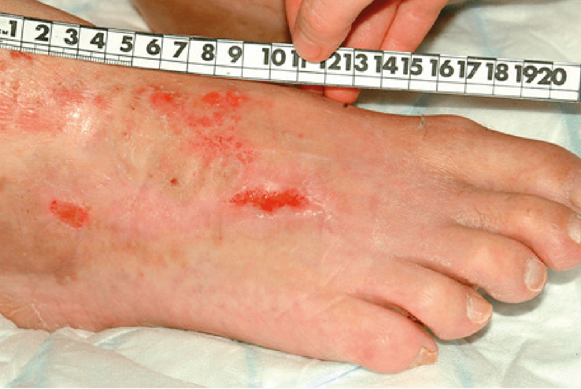 Image of a necrotic foot after treatment with ActivHeal Hydrogel day 24