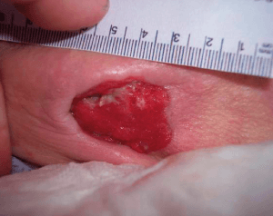 wound case study