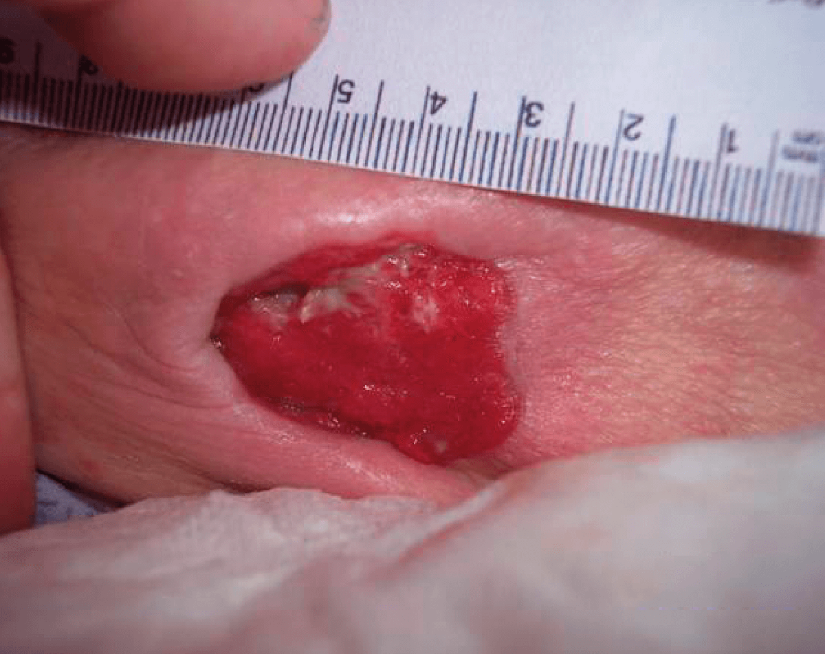 Image of a category 3 moderately exuding pressure ulcer day 1