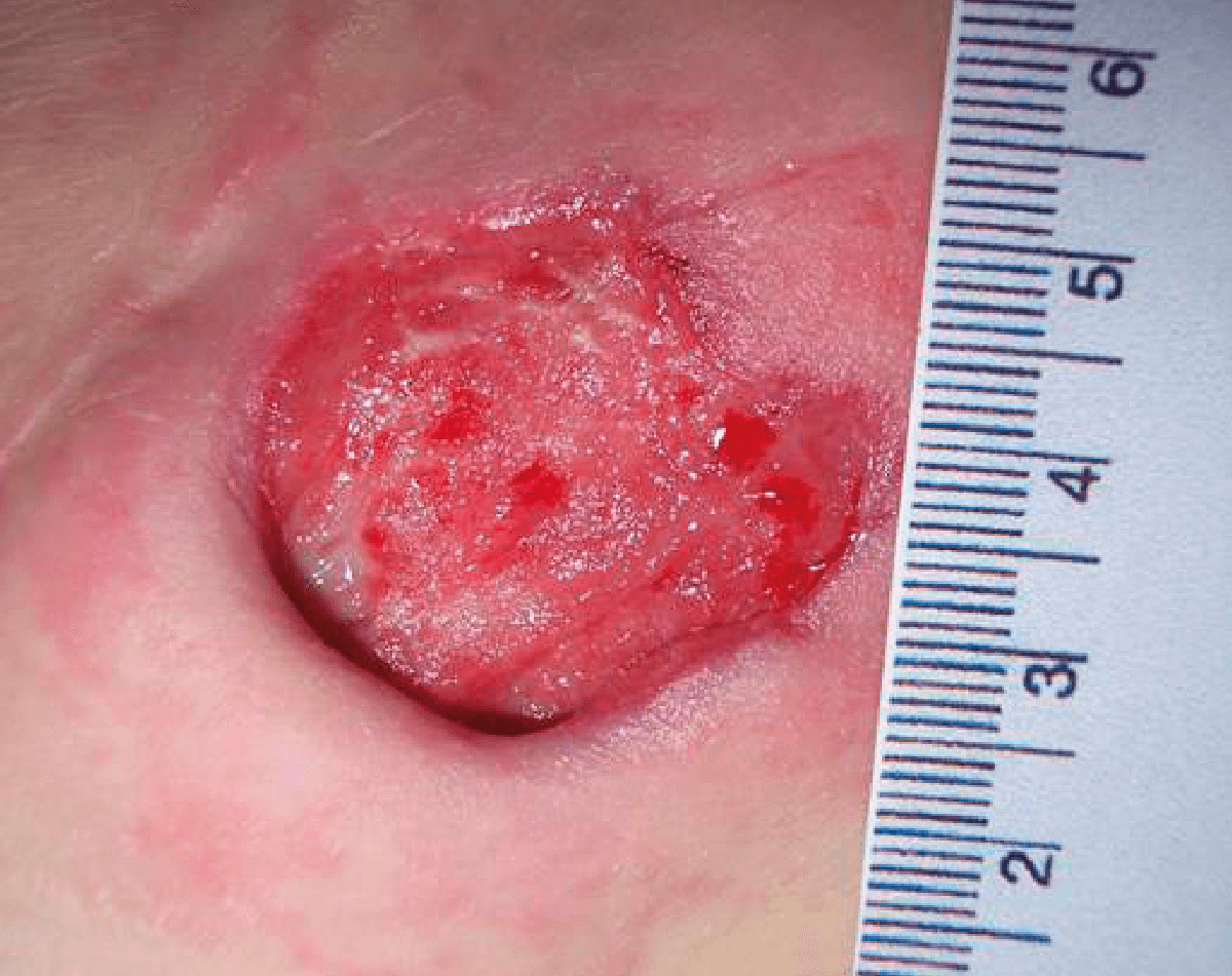 Image of a category 3 moderately exuding pressure ulcer day 9