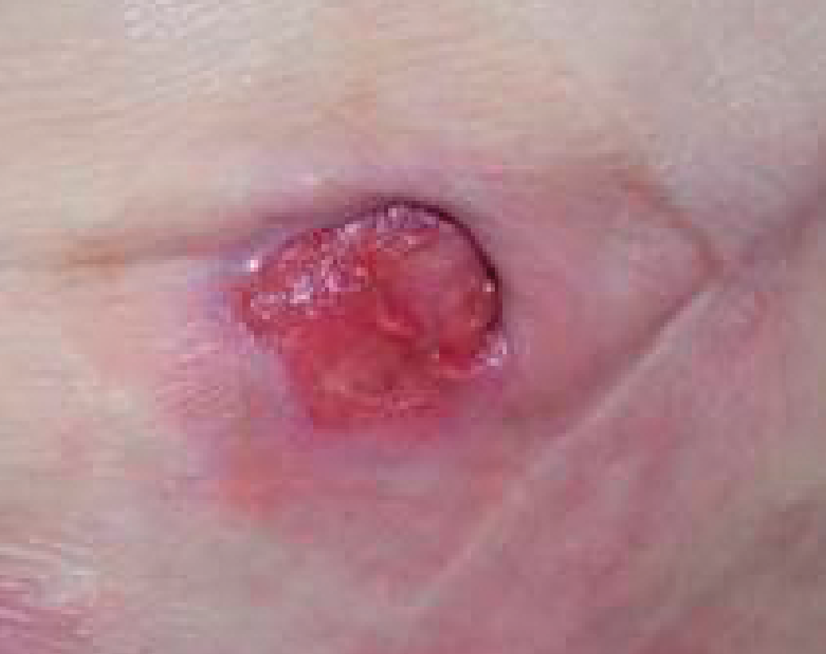 Image of a category 3 moderately exuding pressure ulcer day 24