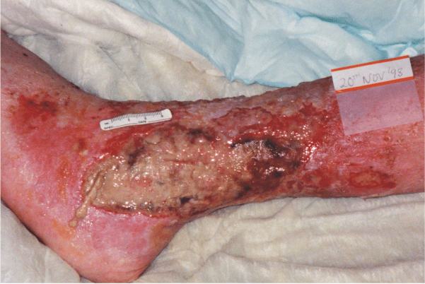 Image of infected tissue