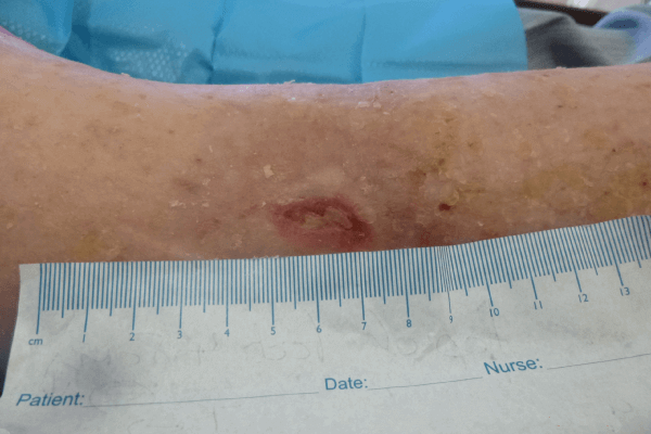 wound bed preparation case study