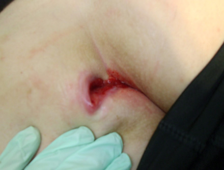 wound care dressing